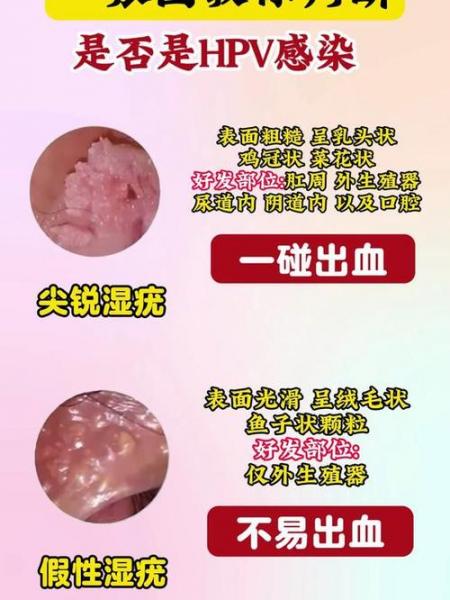 女性怎么判断自己是否感染hpv